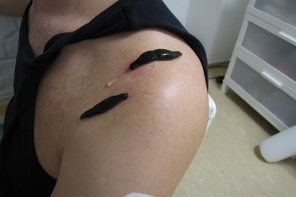 Blutegeltherapie an schmerzhafter Schulter bei Arthrose