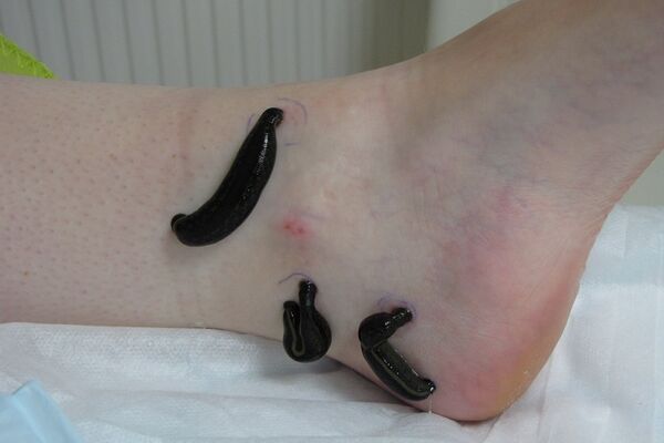 Blutegeltherapie bei Arthrose am Sprunggelenk