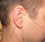Ohrakupunktur . Akupunktur am Ohr in der Naturheilpraxis