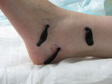 Blutegeltherapie bei aktivierter Arthrose am Fuss