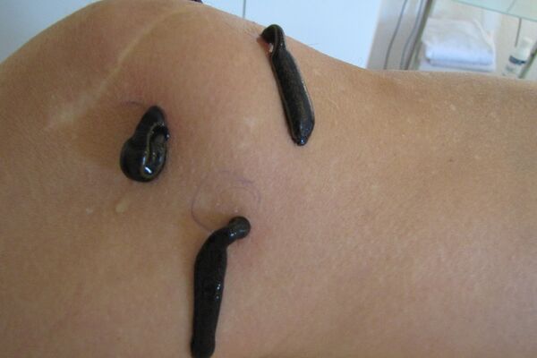 Blutegeltherapie nach Knieoperatio