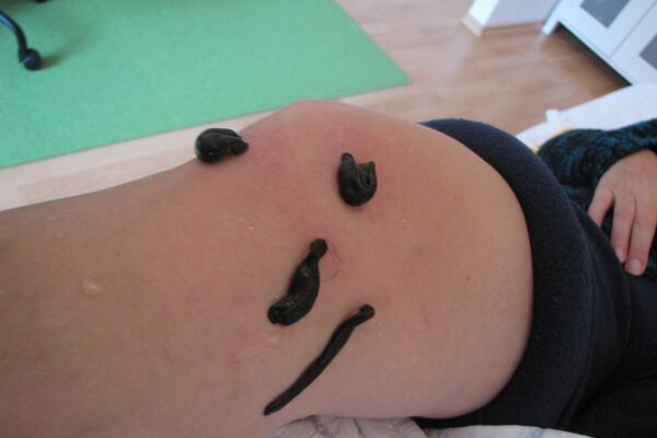 Blutegeltheraie am Knie nach Arthroskopie