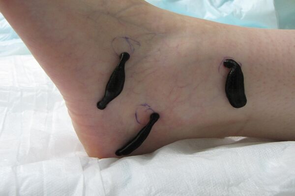 Blutegeltherapie bei aktivierter Arthrose am Fuss