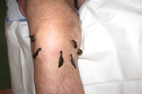 Blutegel am Arthrose Knie