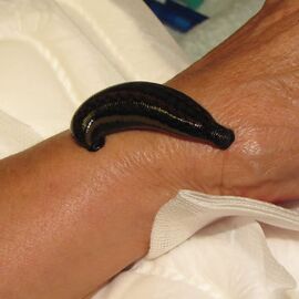 Blutegeltherapie Arthrose