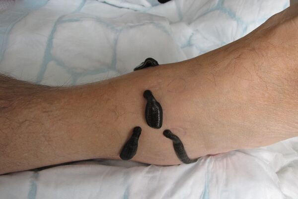 Arthrose Sprunggelenk Blutegeltherapie