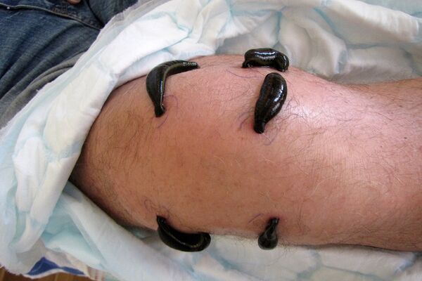 Blutegeltherapie am Knie bei Arthrose mit Schwellung und Schmerzen
