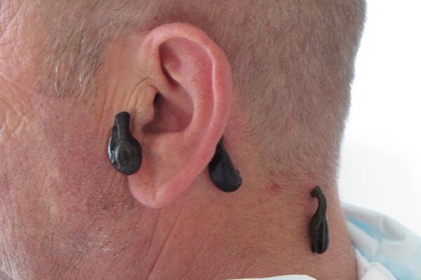 Blutegeltherapie bei Tinnitus