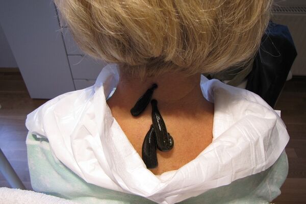 Blutegeltherapie bei Arthrose HWS