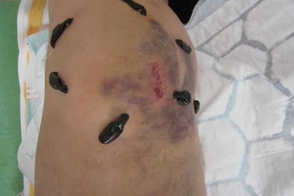 Blutegeltherapie Hämatom am Knie nach Sturz