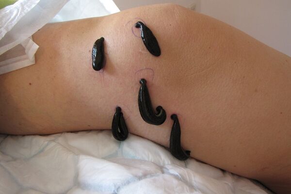 Blutegeltherapie nach Arthroskopie am Knie